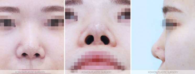Q. Is a change in nose surgery silicone a case that requires revision surgery? image 6