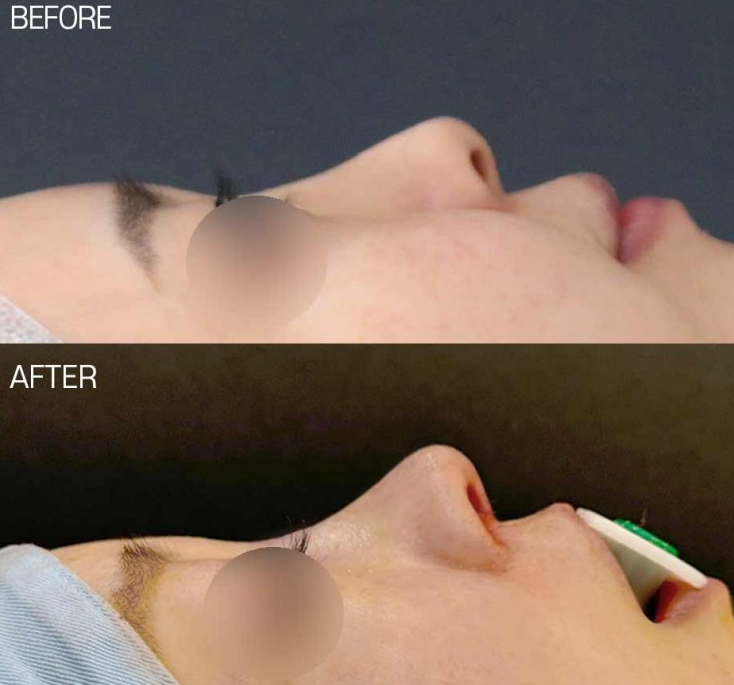 What Is Refined Natural Nose Surgery? Check This If You’re Considering Small Nose Surgery image 2