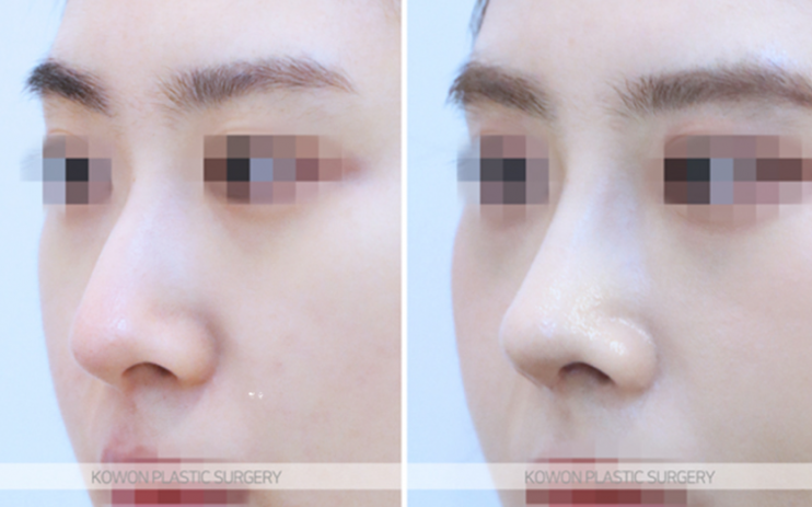 Low Nose Rhinoplasty: A Change to a More Three-Dimensional Impression, 3 Questions About Tip Cartilage Repositioning image 7