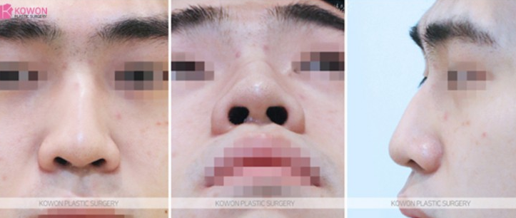 Q. Concerns After Hump Nose Rhinoplasty and Nasal Fracture Surgery: Possibility of Revision Surgery for Men image 4