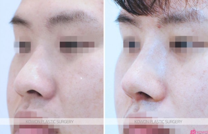 Q. I’m interested in male rhinoplasty and eye surgery—where is a good clinic for male nose surgery? image 7