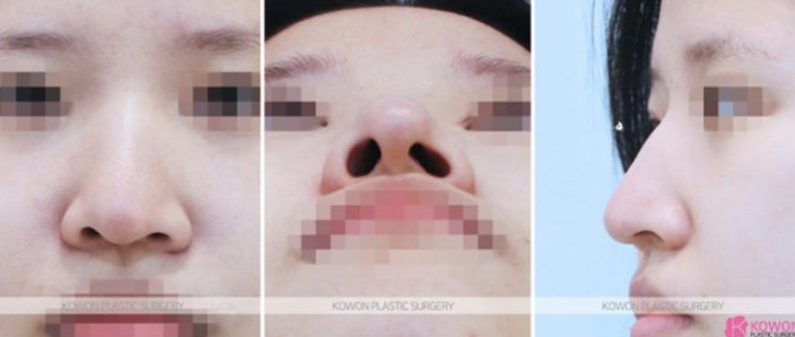 Q. Changes Before and After Hump Nose Surgery: Checking Whether a Nose Tip Dent After Rhinoplasty Is a Side Effect image 4