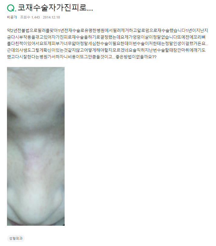 Q. After Surgery Side Effects, Is Revision Surgery with Autologous Dermis Okay? image 2