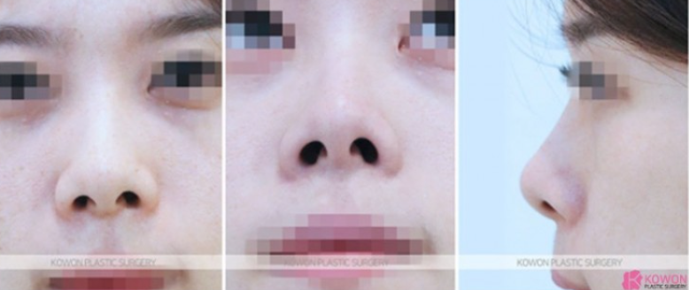 작은코성형에서 입체감 있는 코 라인을 만드는 핵심 3가지 관련 이미지 5