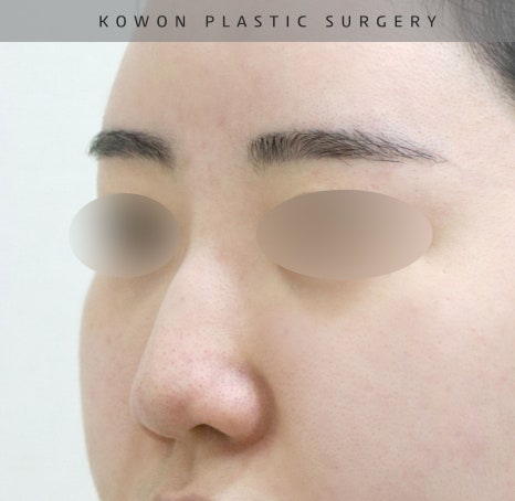 울퉁불퉁해 신경 쓰이던 코를 코원성형외과에서 낮은코와 매부리코교정으로 매끄럽게 만들었어요! 관련 이미지 11