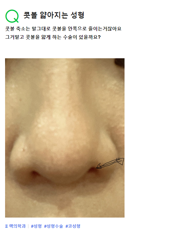 Q. 넓은 콧볼을 안쪽으로 좁게 줄이는 수술? (콧볼축소술) 관련 이미지 2