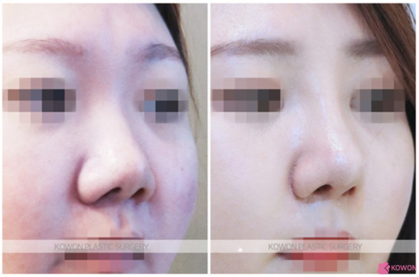 작은코 성형, 짧은 코와 둥근 코끝을 자연스럽게 개선한 코원성형외과 사례 관련 이미지 4
