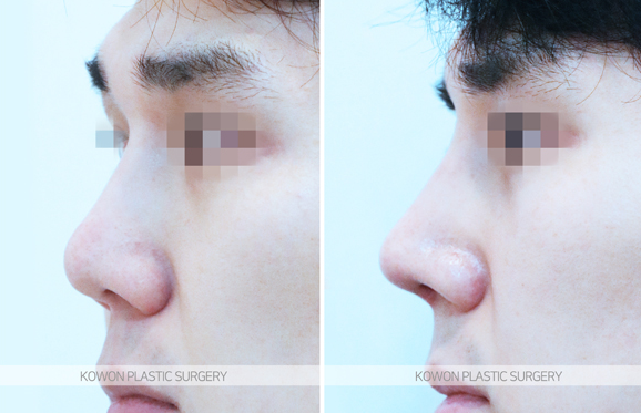 Q. Revision Rhinoplasty Clinic: Can a Crooked Nose Caused by a Bump After Nose Surgery Be Revised? image 3
