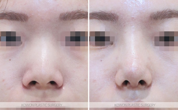 Q. How much swelling is there one month after nose surgery? Questions before rhinoplasty image 10