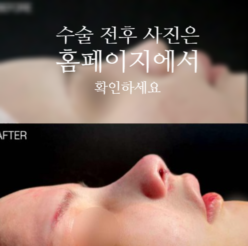 낮은코성형 코끝부터 비순각까지 함께 봐야 하는 3가지 이유 관련 이미지 2