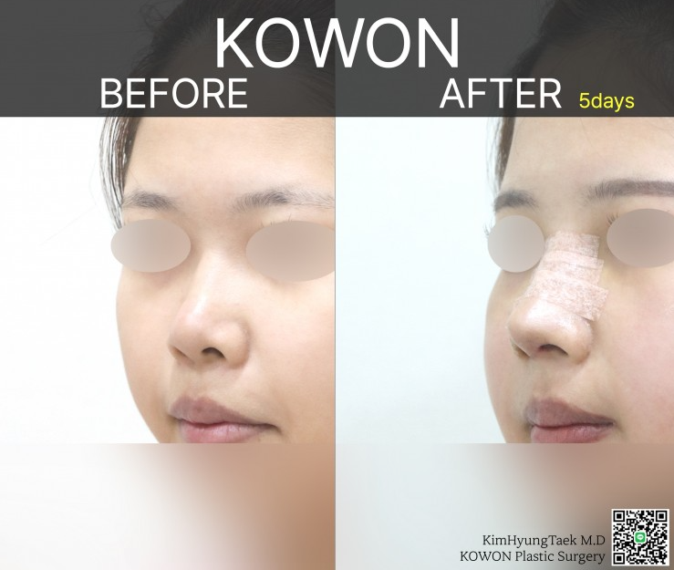 Q. If you're worried about revision rhinoplasty after upturned nose surgery? image 4