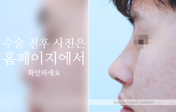 남자복코수술 매부리코와 콧볼을 함께 교정해야 자연스러운 이유 관련 이미지 9