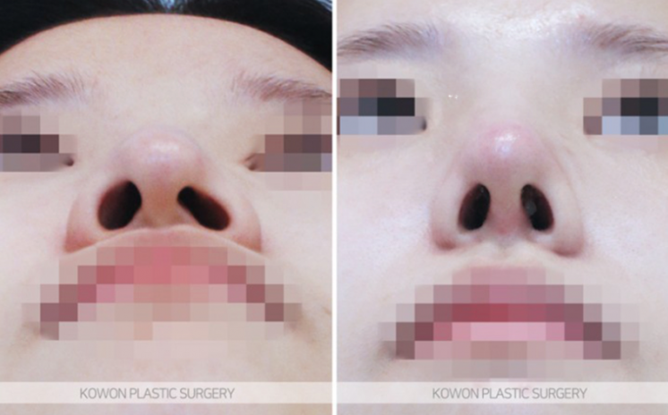 Q. I’m worried about side effects from nose surgery. Please tell me how to reduce swelling after nose surgery. image 9