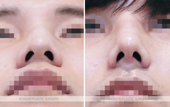 How Long Does Nose Surgery Swelling Last? A Summary of Immediate Changes and the Recovery Process image 6