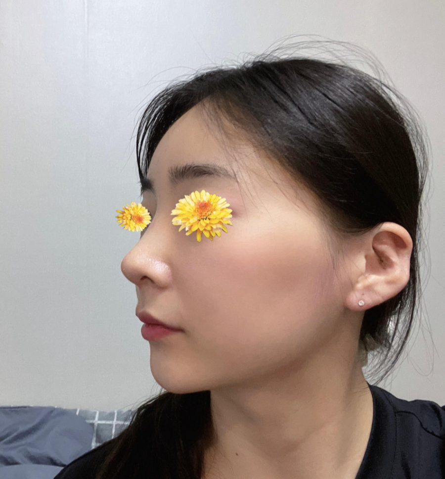 여자매부리코와 화살코 교정을 코원성형외과에서 하고 딱 원하는 라인을 찾게 되었어요! 관련 이미지 6