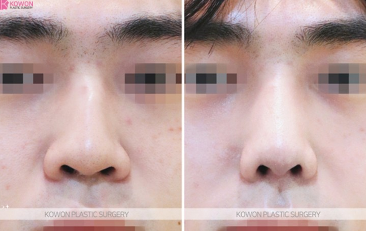 Q. Concerns After Hump Nose Rhinoplasty and Nasal Fracture Surgery: Possibility of Revision Surgery for Men image 6
