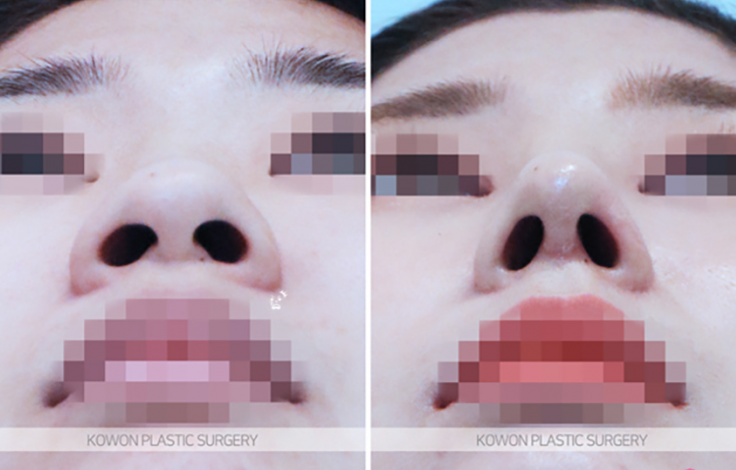 Q. Learn About Changes Before and After Alar Reduction Surgery Without Implants and Alar Reduction Surgical Methods image 6