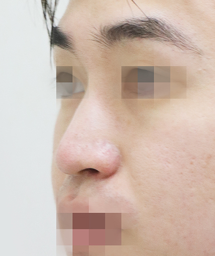 남자코성형전후 매부리코 수술에서 콧대와 코끝을 함께 보는 이유 관련 이미지 4