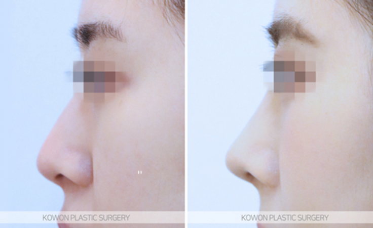 Q. I’m asking because I’m worried about complications after tip surgery and the duration of non-incisional alar reduction. image 7