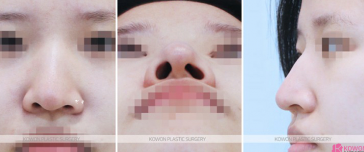 Q. I’m worried about side effects from nose surgery. Please tell me how to reduce swelling after nose surgery. image 4