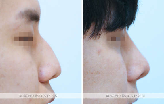 How Long Does Nose Surgery Swelling Last? A Summary of Immediate Changes and the Recovery Process image 8