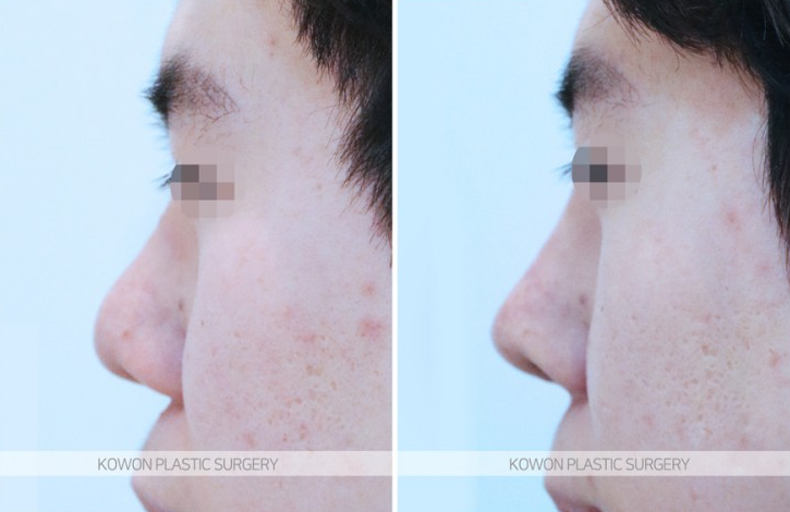 Q. Noble Surgery Implant Effect: The Swelling Period Has Passed, But... image 3