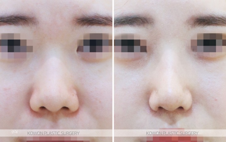 Q. Is Kangnam nose revision surgery necessary for a nose tip surgery complication? image 9