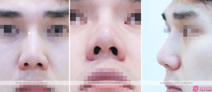 Q. When Is Revision Nose Surgery or Nose Reconstruction Surgery Needed, and Tips for Choosing a Well-Known Revision Nose Surgery Clinic image 5