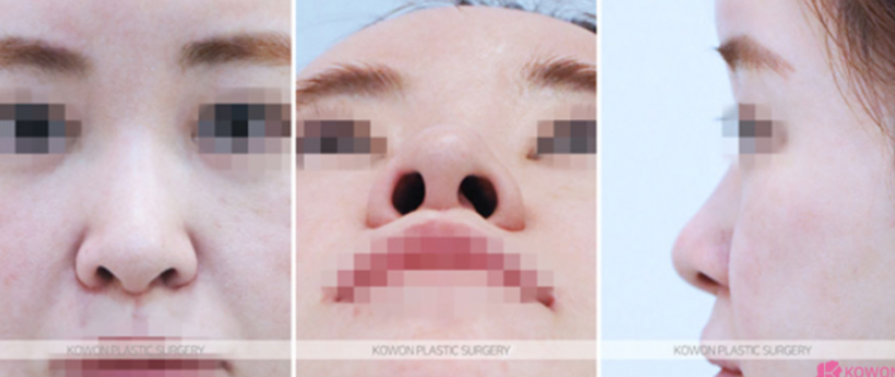 Natural Nose Line Improvement Process Seen Through Changes Before and After Cartilage Stitching at the Nasal Tip image 5