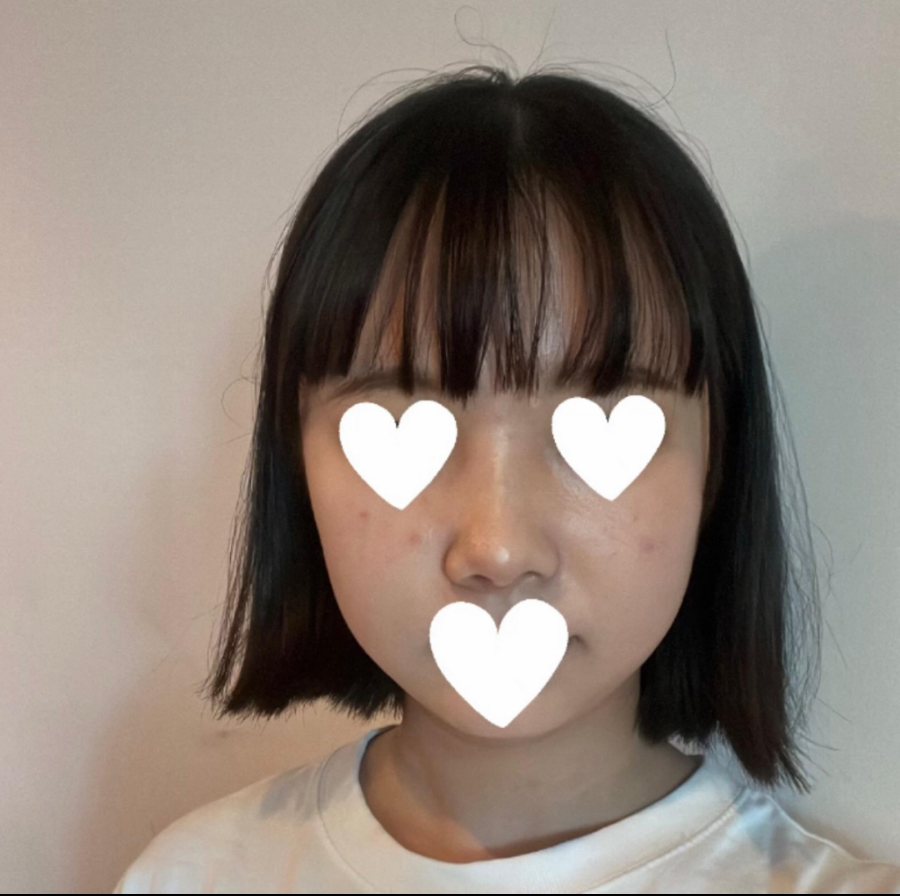 I Was Reborn with Small, Bulbous Nose Correction and Functional Nose Surgery for Deviated Septum at Kowon Plastic Surgery image 1
