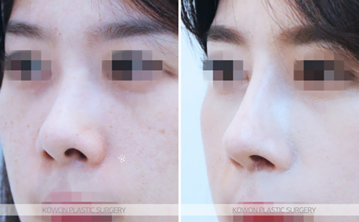 Q. Questions About Bulbous Nose Surgery and Post-Jaw Surgery Nose Surgery Answered image 6