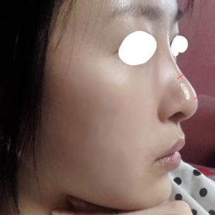 Q. After surgery on the nasal tip and bridge, I think my nose has become an arrow nose image 5