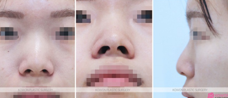 Q. How much swelling is there one month after nose surgery? Questions before rhinoplasty image 5