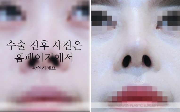 낮은코성형 코끝부터 비순각까지 함께 봐야 하는 3가지 이유 관련 이미지 8
