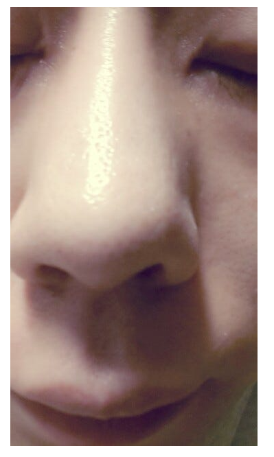 Q. My nose looks artificial because of swelling after bulbous nose surgery. Should I get revision rhinoplasty? image 5