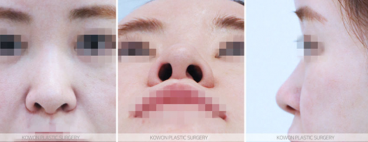 Q. Concerned about revision surgery for a long and wide nose: What is the key to natural-looking nose surgery results? image 4