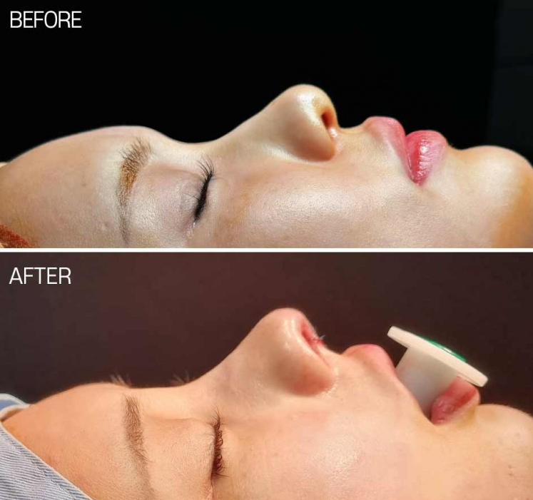 Q. When having bulbous nose surgery and nostril reduction, is cutting the alar rim enough? image 4