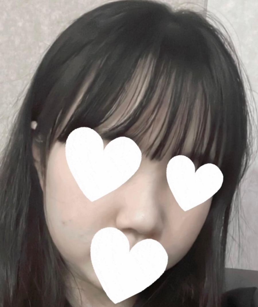 I Was Reborn with Small, Bulbous Nose Correction and Functional Nose Surgery for Deviated Septum at Kowon Plastic Surgery image 4