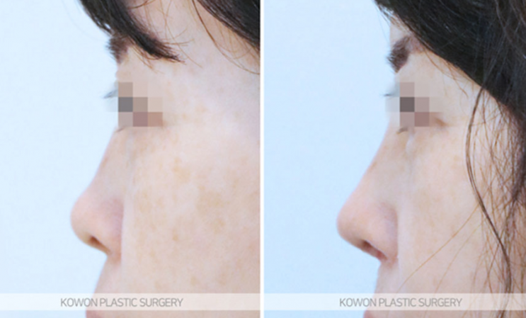 Q. I’m considering nose surgery in Seoul, and I have questions about the methods and safety of rhinoplasty image 9