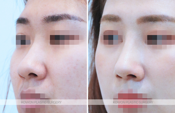 코끝연골재배치 어떤 변화가 나타날까요? 복코 라인 개선 과정 정리 관련 이미지 5