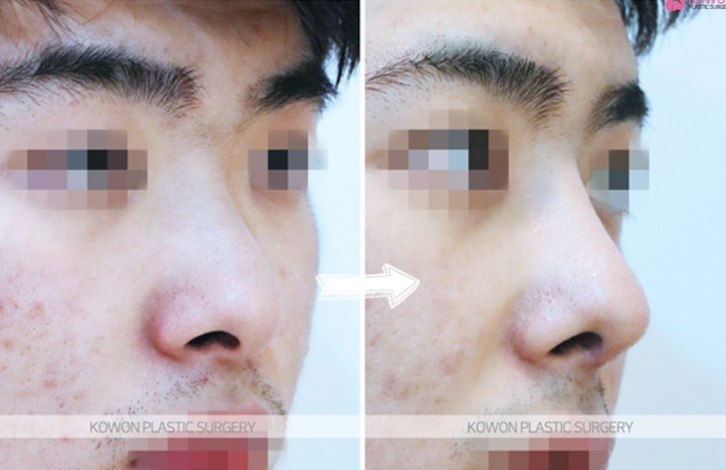 Q. Is it just a simple issue after male rhinoplasty in Gangnam? Resolving concerns about revisional surgery for nasal inflammation image 9