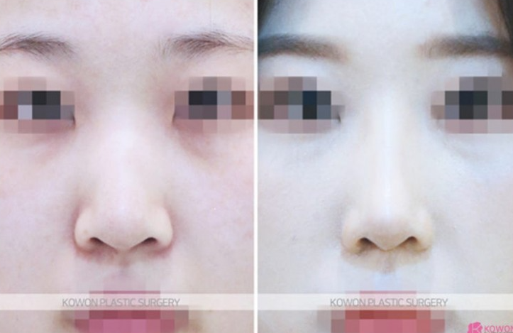 Q. Nasal Bone Fracture Rhinoplasty: Can I Correct a Crooked Nose and Raise the Bridge Even Though It’s Broken? image 4