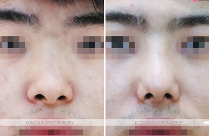 Q. Is it just a simple issue after male rhinoplasty in Gangnam? Resolving concerns about revisional surgery for nasal inflammation image 7