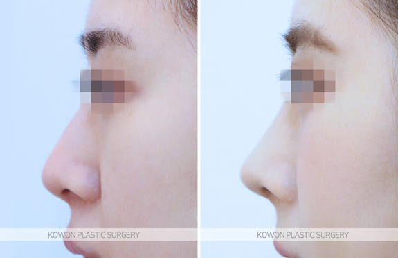 Q. Would nose fat-dissolving injections be effective? I’m wondering whether bulbous nose surgery or tip surgery is necessary image 5