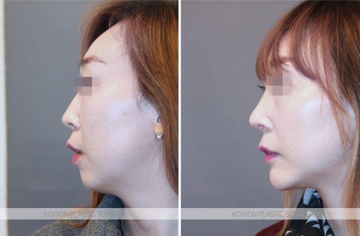 Q. Noble Surgery Implant Effect: The Swelling Period Has Passed, But... image 4