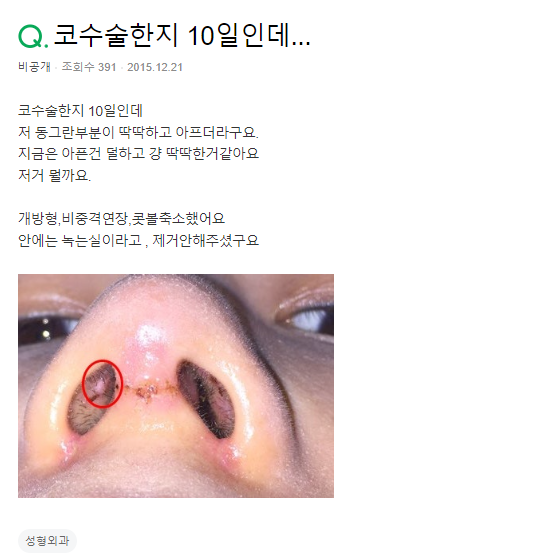 Q. 코수술 10일차, 이게 뭘까요? 관련 이미지 2