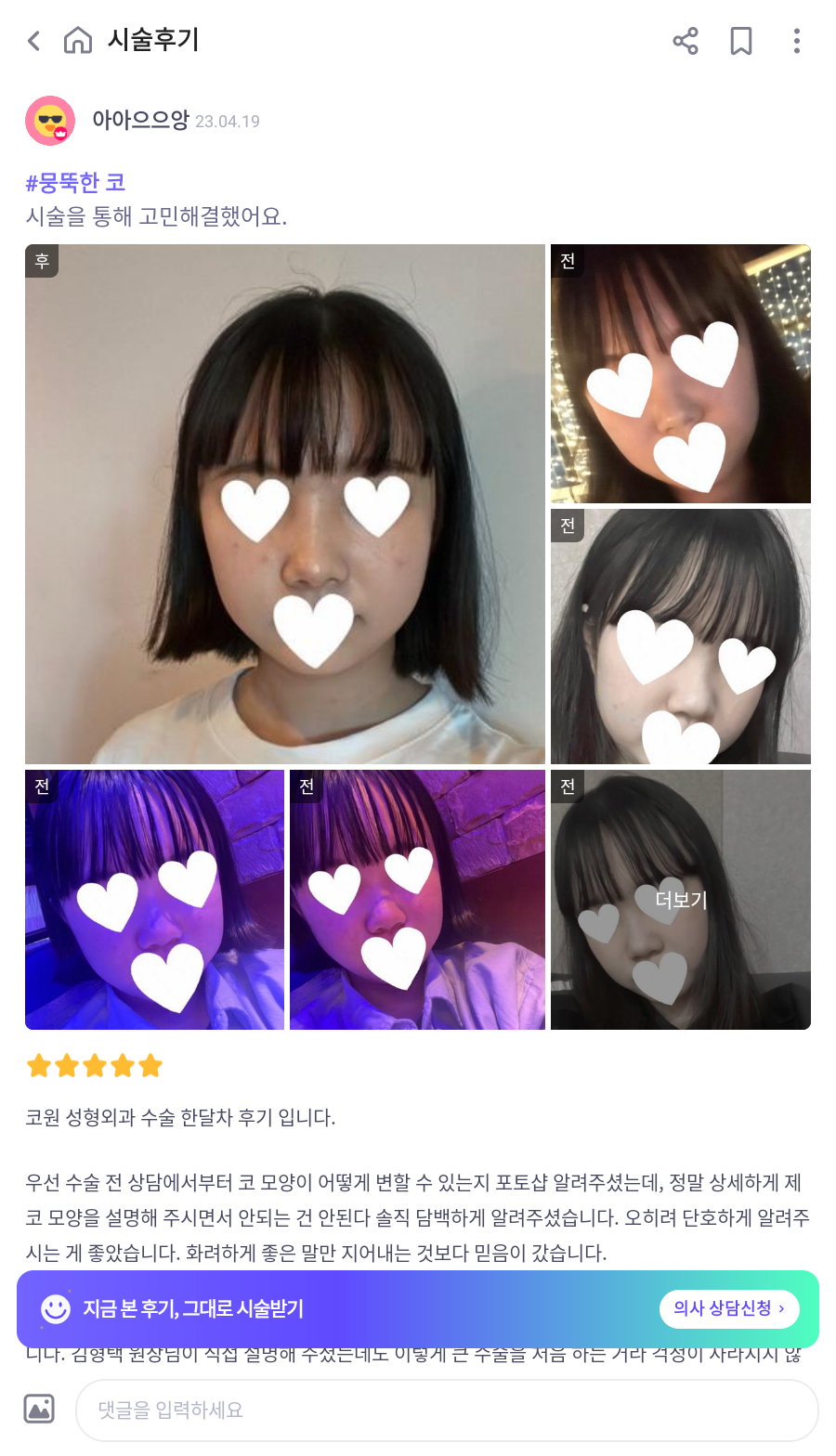 I Was Reborn with Small, Bulbous Nose Correction and Functional Nose Surgery for Deviated Septum at Kowon Plastic Surgery image 10