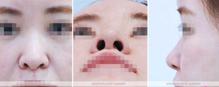 Q. 화살코코끝수술 후 고민, 어떤 코수술종류가 필요한지 궁금해요 관련 이미지 4