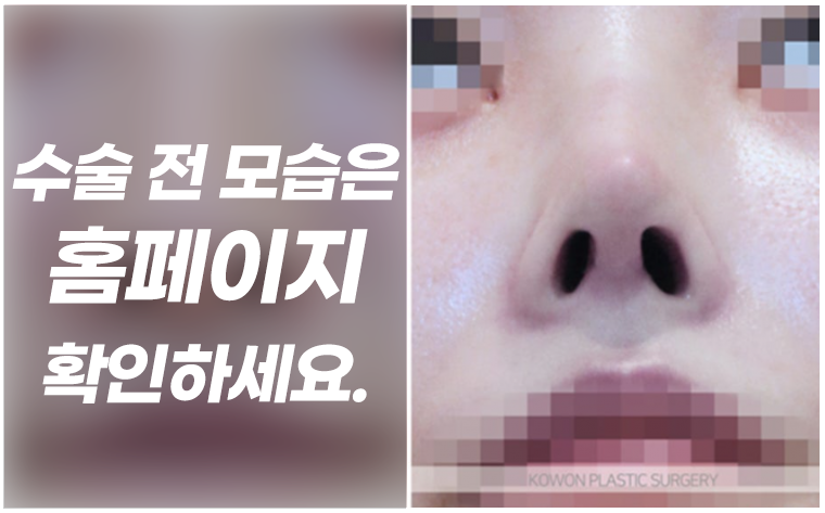 용코 교정 실제 사례로 보는 콧구멍 노출 완화와 세련된 코 라인 관련 이미지 4