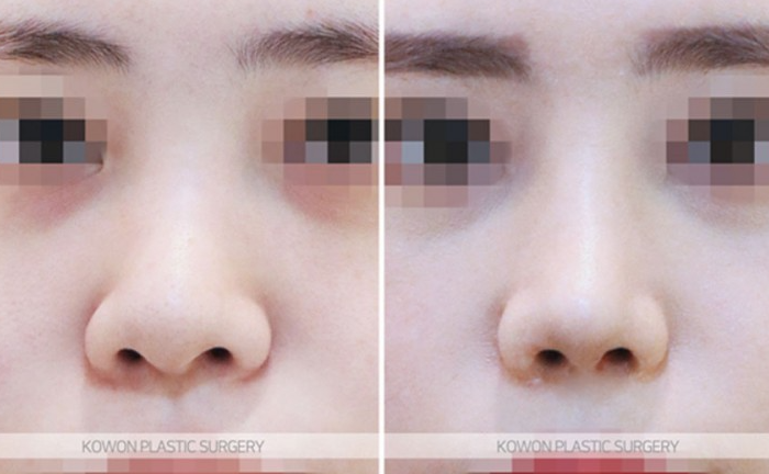 Q. Can I Have a Non-Implant Nose Surgery Along with Changes Before and After Bulbous Nose Surgery? image 6